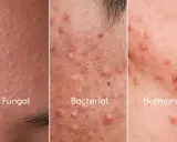 Comparación de tipos de acné: Fungal, con pequeños bultos; Bacterial, con pústulas y granos; Hormonal, con rojeces y protuberancias.
