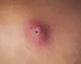 Gros plan d'un furoncle sur la cuisse, rouge et enflammé, avec un centre sombre.
