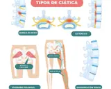 ¿Es ciática? Reconoce síntomas, causas y cuándo actuar