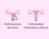 Ilustración de útero con DIU, deslizamiento, perforación, enfermedad inflamatoria pélvica e infección uterina. Reposo tras colocar el DIU Mirena.