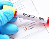 Hiperprolaktynemia: objawy, diagnostyka i jak obniżyć prolaktynę?