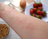 Czerwone, swędzące bąble na skórze, przypominające objawy alergii u dzieci 3 letnich, po kontakcie z truskawkami i jajkiem.