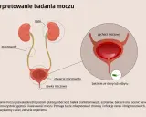 Schemat układu moczowego z nerkami, moczowodami, pęcherzem i cewką. Ilustracja pokazuje różne rodzaje moczu i bakterie.