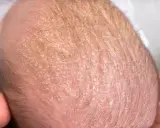 Testa di neonato con crosta lattea, squame giallastre e sottili capelli scuri.