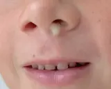 Un bambino ha un po' di muco trasparente dal naso che cola.