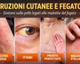 Eruzioni cutanee, ittero, prurito e angiomi stellati: sintomi di malattie epatiche. Attenzione, il cortisone fa male al fegato.