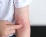 Un bras montre des rougeurs et des irritations, signe d'un possible stress peau.