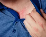 Pelle arrossata e irritata sul collo, possibile dermatite da stress. Una mano solleva il colletto di una camicia blu.