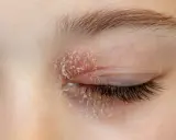 Gros plan sur un œil fermé présentant une peau sèche et squameuse, signe d'une mycose autour des yeux.