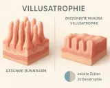 Confronto tra villi intestinali sani e atrofizzati, tipici della celiachia. La celiachia danneggia i villi, riducendone l'assorbimento.