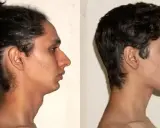 Comparación de perfiles faciales. El lado izquierdo muestra una mandíbula retraída, mientras que el derecho, tras practicar que es mewing, revela un perfil más definido.