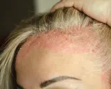 Cuir chevelu irrité avec des plaques rouges et des squames de peau morte, près des cheveux blonds.