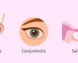 Ilustración muestra uretritis, conjuntivitis y salpingitis, afecciones que puede causar la clamidia.