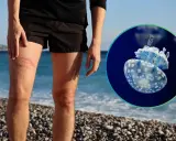 Gamba con segni rossi, forse da medusa. Immagine di una medusa blu e bianca. Cosa fare se ti tocca una medusa.
