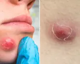 Gros bouton douloureux sur la joue, rouge et enflammé, prêt à percer. Gros plan sur une lésion cutanée similaire.