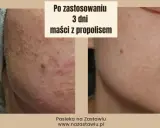 Przed i po 3 dniach stosowania maści z propolisem. Skóra z niedoskonałościami staje się gładsza.