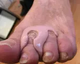 Orthoplastie podologue : un pansement rose est appliqué entre les orteils pour soulager une douleur.