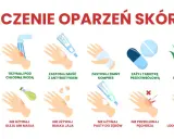 Leczenie oparzeń skóry: chłodna woda, maść z antybiotykiem, zimny kompres, leki przeciwbólowe, aloes. Unikaj masła, jajek, pasty do zębów, przekłuwania pęcherzy, lodu.