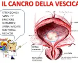 Illustrazione anatomica della vescica maschile con un'area evidenziata che indica un tumore alla vescica. Avviso: sangue e bruciore durante la minzione richiedono visita medica immediata.