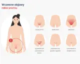Ilustracja pokazuje wczesne objawy raka sromu: świąd, pieczenie, dyskomfort, zgrubienia, grudki i owrzodzenia.