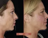 Prima e dopo: il filler full face ha ridefinito i contorni del viso, migliorando la pienezza e la definizione.