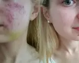 Przed i po leczeniu izotretynoiną: skóra z trądzikiem i zaczerwienieniem po lewej, gładka i czysta po prawej.