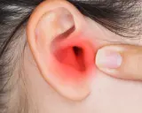 Dito un orecchio con un'area rossa che indica infiammazione, forse dovuta a pseudomonas aeruginosa orecchio.