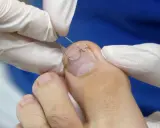 Application d'une orthonyxie sur un ongle incarné. Des mains gantées ajustent un fil métallique pour corriger la courbure de l'ongle.