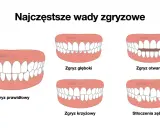 Ilustracje pokazują różne wady zgryzu: prawidłowy, głęboki, otwarty, krzyżowy i stłoczenia zębów.