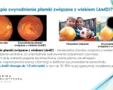 Badanie dna oka co wykrywa: zdrowe oko vs. zwyrodnienie plamki związane z wiekiem (AMD), wpływające na widzenie.