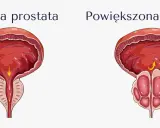 Porównanie zdrowej i powiększonej prostaty. Powiększona prostata może powodować problemy z oddawaniem moczu, co jest jednym z objawów przerostu gruczołu krokowego.