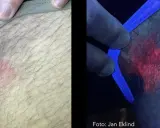 Hudförändring som kan vara leishmania hos människa. Till vänster syns en röd, fjällande fläck. Till höger, under UV-ljus, lyser fläcken starkt rött.