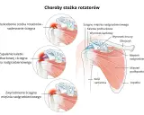 Ilustracja przedstawia budowę stawu barkowego i schorzenia mięśnia nadgrzebieniowego: naderwanie, zapalenie kaletki i zwyrodnienie ścięgna.