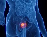 Widok anatomiczny ukazujący nowotwór złośliwy pęcherza moczowego.