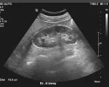Badanie USG nerki prawej. Obraz pokazuje strukturę nerki, z zaznaczonymi pomiarami. Pytanie, czy torbiel na nerce może się wchłonąć, jest kluczowe w diagnostyce.