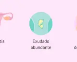 Ilustración de vaginitis, exudado y picazón vaginal, síntomas comunes de tricomoniasis.