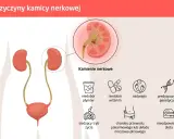 Ilustracja pokazuje, skąd się biorą kamienie nerkowe: niedobór płynów, witamin, nadwaga, predyspozycje genetyczne, siedzący tryb życia, choroby układu pokarmowego i moczowo-płciowego, nieodpowiednia dieta.