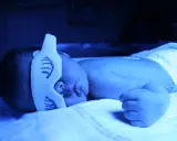 Neonato sotto lampada blu per curare l'ittero, con mascherina protettiva sugli occhi.