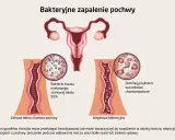 Ilustracja porównuje zdrową pochwę z dominującymi bakteriami kwasu mlekowego do waginozy bakteryjnej, gdzie przeważają bakterie chorobotwórcze.
