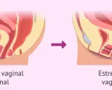 Ilustración comparativa de la abertura vaginal normal y la estrechez vaginal, donde se aprecian espasmos musculares en la segunda.