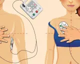 Instrukcja użycia defibrylatora serca. Elektrody przyklejane są do klatki piersiowej mężczyzny i kobiety, zgodnie z rysunkami.