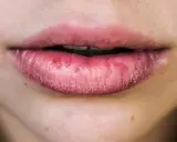 Labbra secche e screpolate, con segni di irritazione. Le cause possono essere molteplici, dal freddo alla disidratazione.