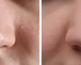 Avant/après : peau du nez avec points noirs avant et après extraction, montrant une peau plus lisse et nette.