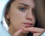 Jak wyciskać pryszcze bezpiecznie? Ekspert radzi!