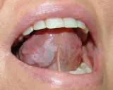 Lingua con aree biancastre, possibile leucoplachia, che potrebbe indicare un tumore alla lingua.