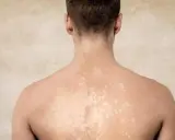 Dos de homme montrant des taches blanches sur la peau, possiblement dues à une exposition au soleil.