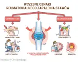Wczesne oznaki reumatoidalnego zapalenia stawów: sztywność, opuchlizna, zmęczenie, gorączka, utrata apetytu. Test na RZS.