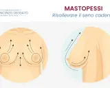 Mastopessi: solleva il seno cadente. Immagine illustra il seno prima e dopo il sollevamento, con frecce che indicano il movimento verso l'alto.