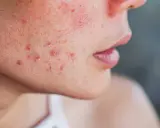 Gros plan sur une joue présentant des rougeurs et des boutons, symptômes d'acné rosacée.