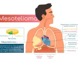 Il mesotelioma è un tumore che colpisce il mesotelio, il sottile strato che riveste gli organi interni. L'immagine mostra dove può svilupparsi.